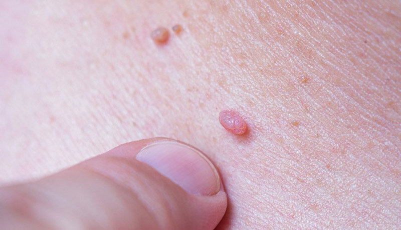 انتقال ویروس زگیل در اماکن ورزشی و راه‌های پیشگیری