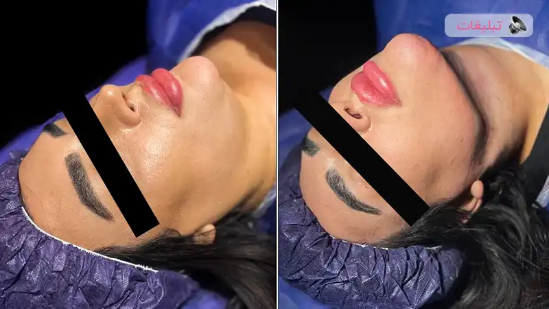 روش مؤثر لیپوساکشن غبغب برای داشتن چهره‌ای متناسب و طبیعی