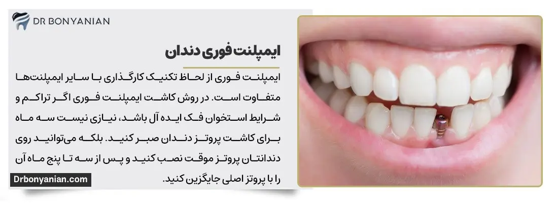 راهنمای کامل انتخاب مرکز ایمپلنت فوری دندان
