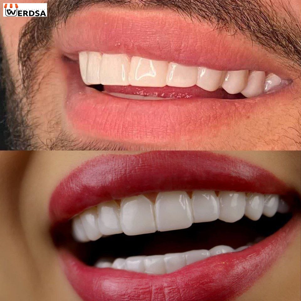 لمینت دندان snap on smile برای خرابی 6 دندان(شرکت وردسا)