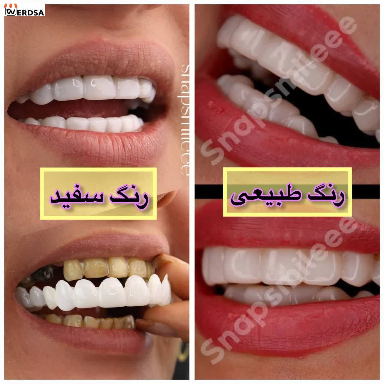 لمینت دندان snap on smile برای خرابی 4 دندان شرکت وردسا