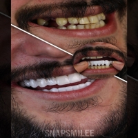 لمینت متحرک دندان truesmile با جایزه 400 تومانی عینک بلک فرایدی