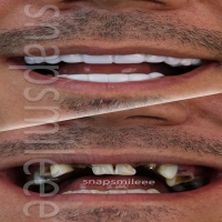 لمینت دندان حرفه ایی آلمانی برای خرابی 10 دندان با عینک دودی هدیه رایگان