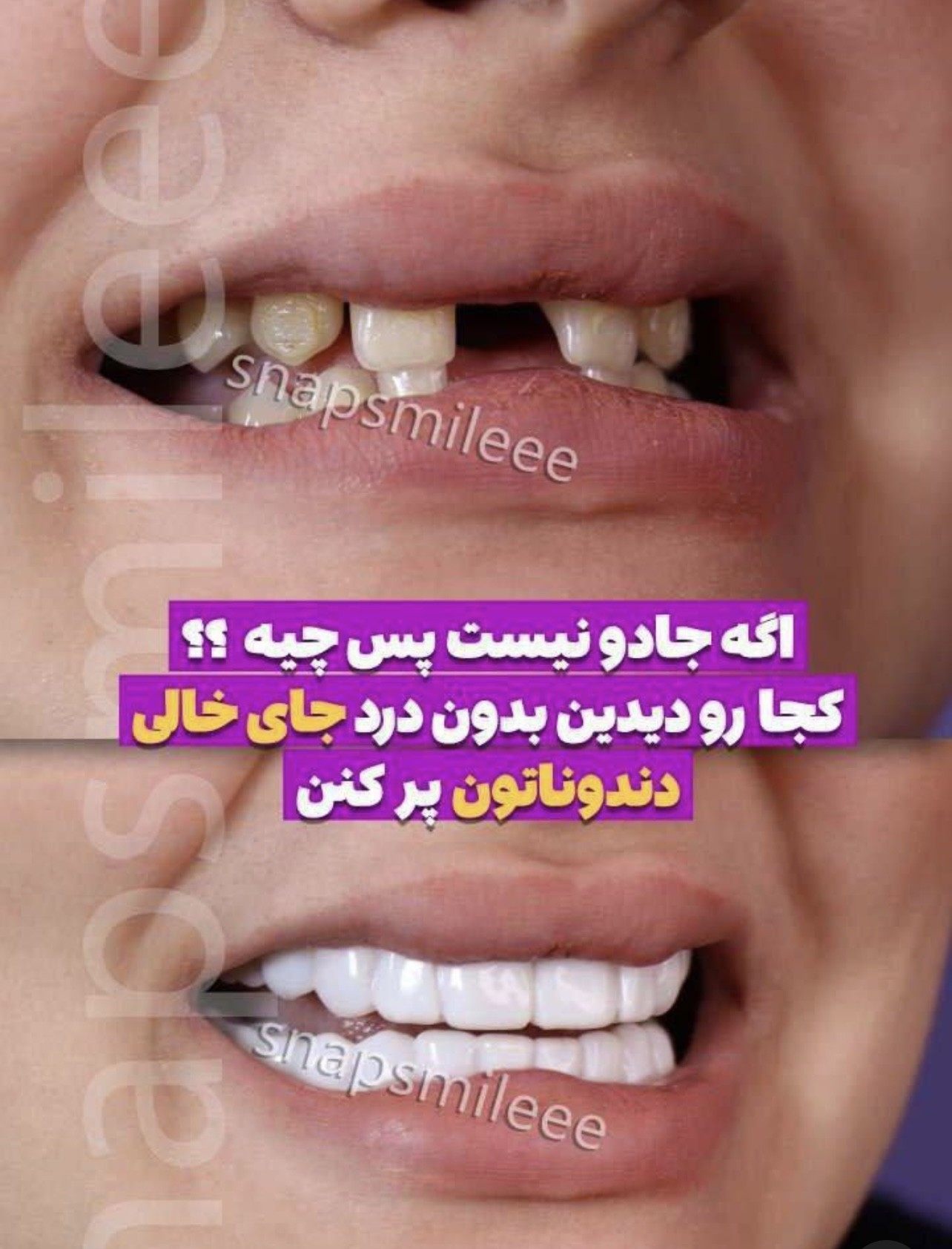 روکش دندان اسنپ اسمایل