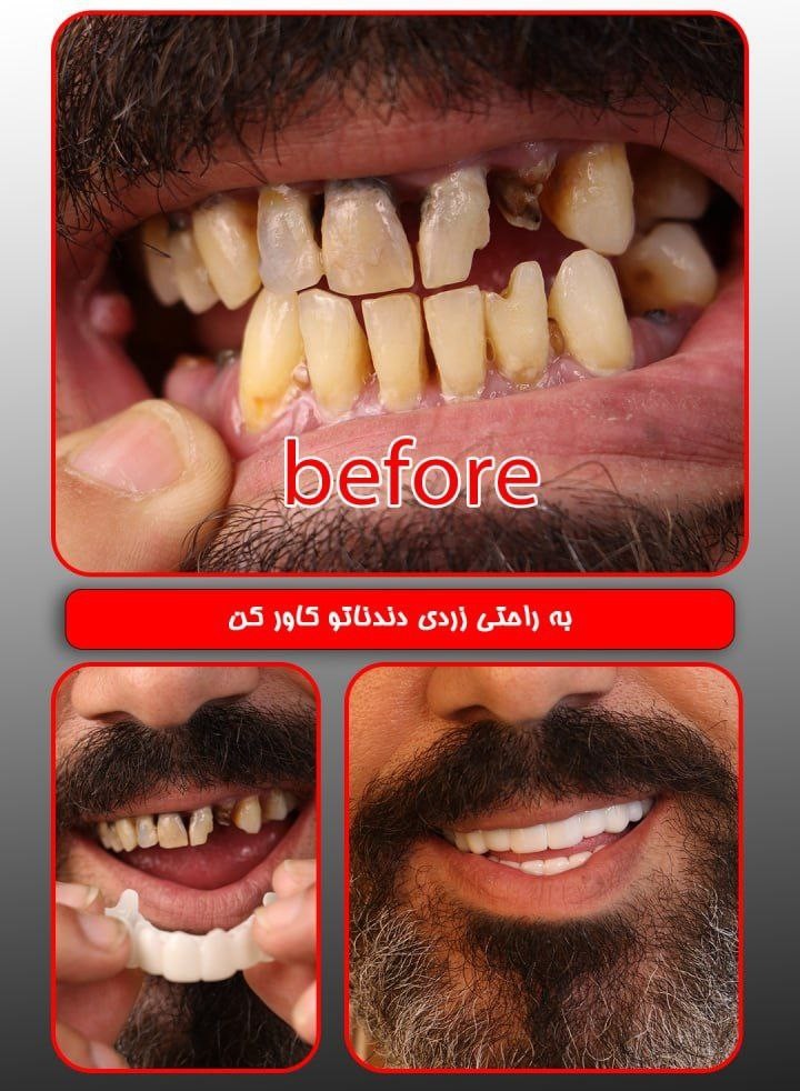 روکش دندان یخی طبیعی